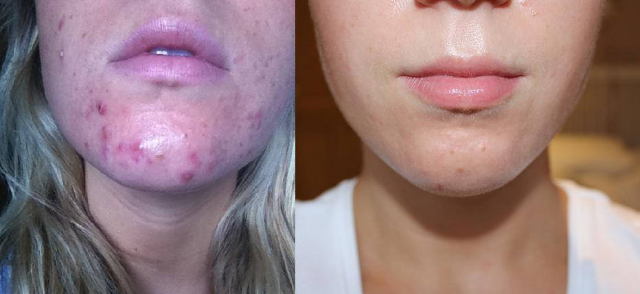 Acne Treatments and Cures