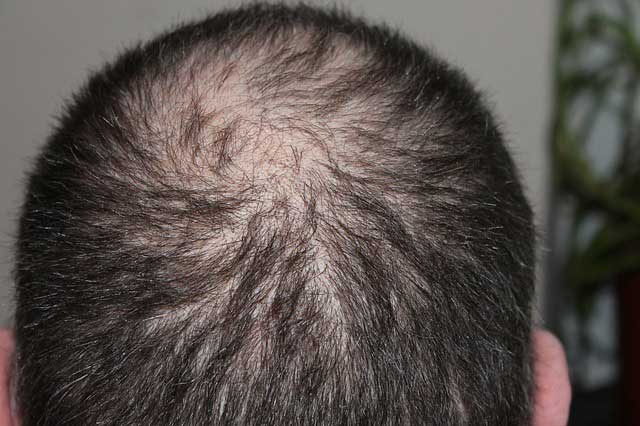 Hair Loss in younger men