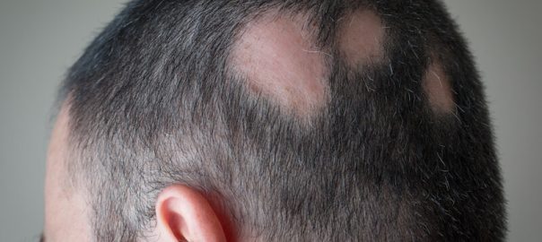 Hair Loss patches